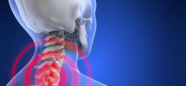 Cervical eskualdeko osteokondrosia