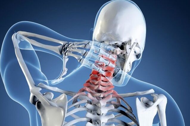 Cervical eskualdeko osteokondrosia