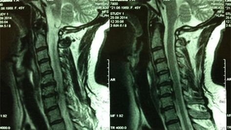 Cervical Saileko MRI
