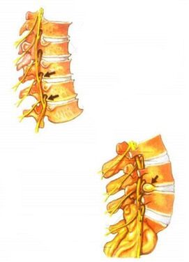 bizkarrezurreko osteokondrosiaren ilustrazioa